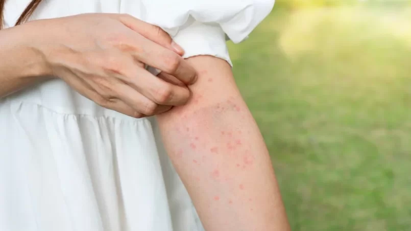 woman hand scratching itchy skin