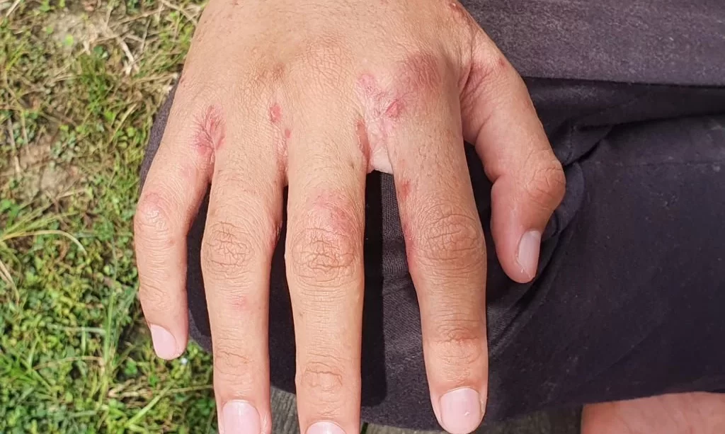 hand with with ulcer filled with pus condition caused of scabies infection