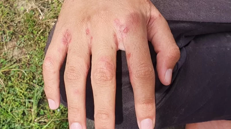 hand with with ulcer filled with pus condition caused of scabies infection